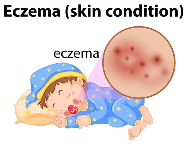 This blog is a comprehensive guide to understanding and managing baby eczema. We explore the causes and symptoms of eczema in infants, as well as the various treatment options available, including topical creams, identifying and avoiding allergen triggers, and seeking medical intervention when necessary. We also provide tips and recommendations for managing baby eczema, such as maintaining a regular skin care routine and avoiding certain fabrics and detergents. This resource is ideal for parents who want to learn more about baby eczema and how to manage it effectively.