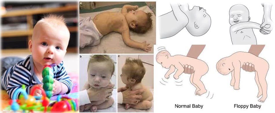 This blog post is an informative guide for parents of infants with hypotonia, also known as floppy muscle syndrome. It covers topics such as the definition and causes of hypotonia, the symptoms and diagnosis process, and the treatment options including physical therapy. By reading this post, parents will have a better understanding of the condition and the various options available for treatment, helping them make informed decisions for their child's health and well-being.