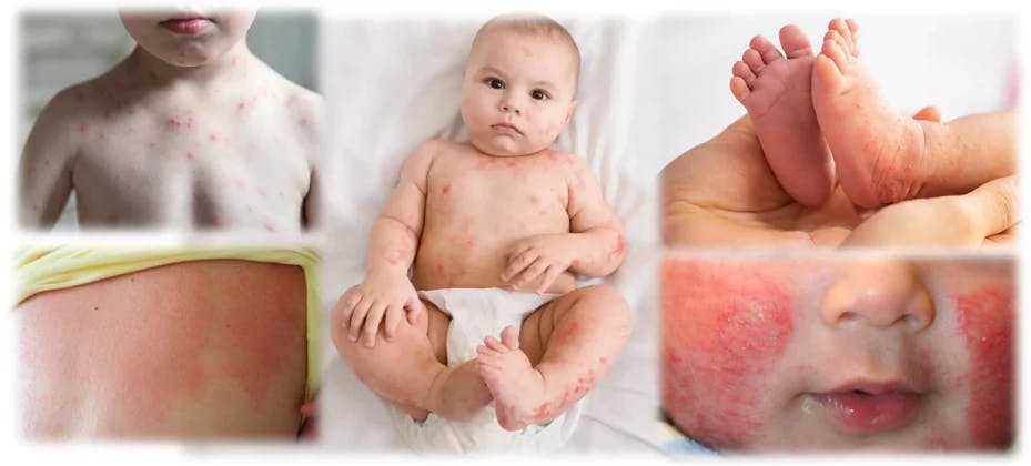Learn about viral rashes in infants, including types, symptoms, and available treatments. Discover the common types of viral rashes, such as Roseola, Chickenpox, Measles, Hand, Foot and Mouth Disease, Fifth Disease, Molluscum, and Rubella. Read on to understand how to identify and diagnose a viral rash in babies, how to prevent spreading, and the available treatment options.