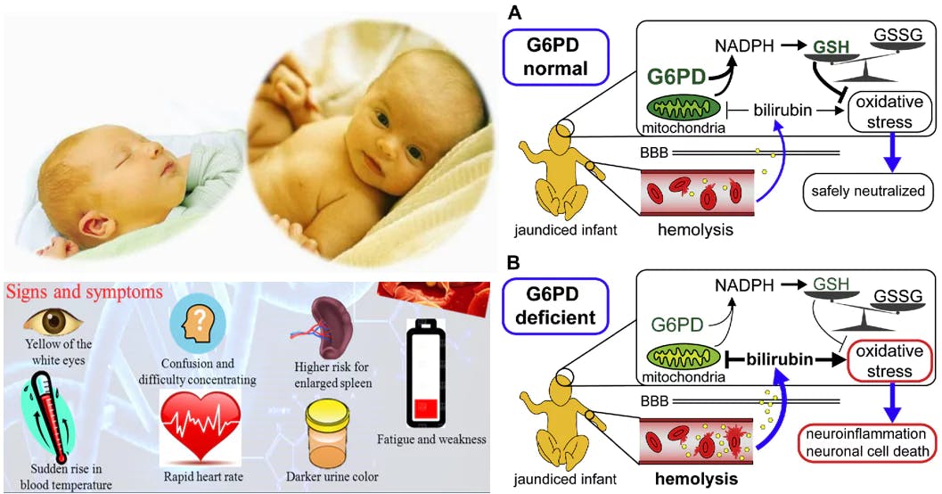G6PD deficiency is a genetic condition that affects the red blood cells, leading to hemolytic anemia. In this blog, you will learn about the causes, symptoms, diagnosis, treatment, and precautions to take to avoid hemolysis. Discover how this condition is diagnosed, what medications to avoid, and what precautions to take.
