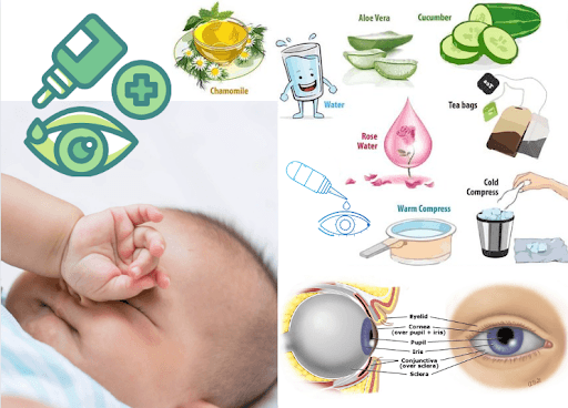 Conjunctivitis (Red Eye) in Children: Causes, Homecare, and Treatment