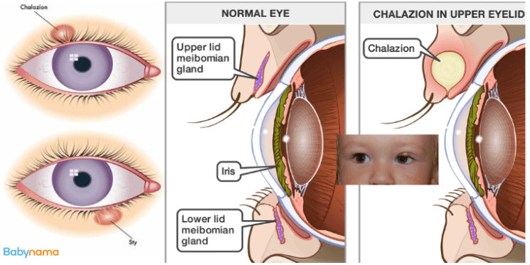 Childhood Chalazion in Babies: Symptoms, Causes, and Treatment