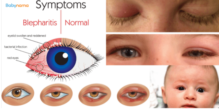 All About The Pediatric Blepharitis