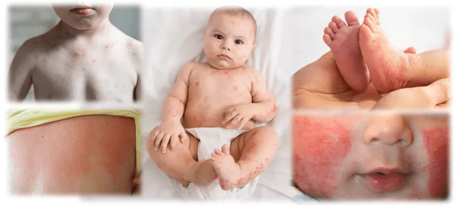 Viral rash in infants – Does my baby have a rash due to a virus?
