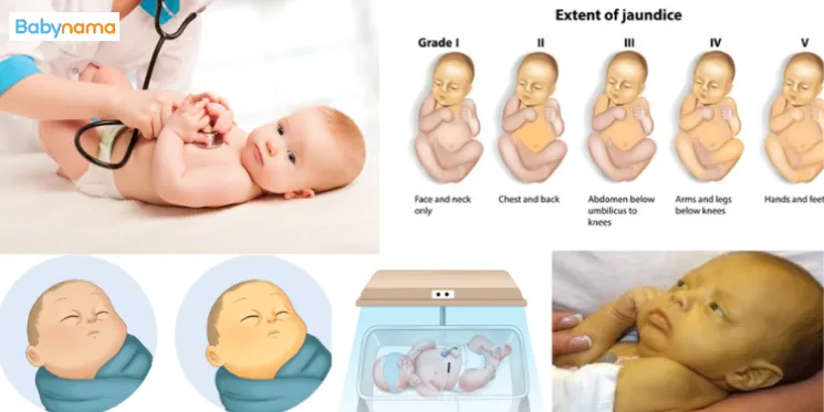 Jaundice in Babies and Newborns