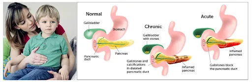 Common Cold in Children