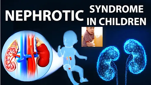 Nephrotic Syndrome in Children: Causes, Symptoms & Treatment